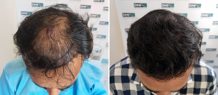 DHI before & after hair transplant results